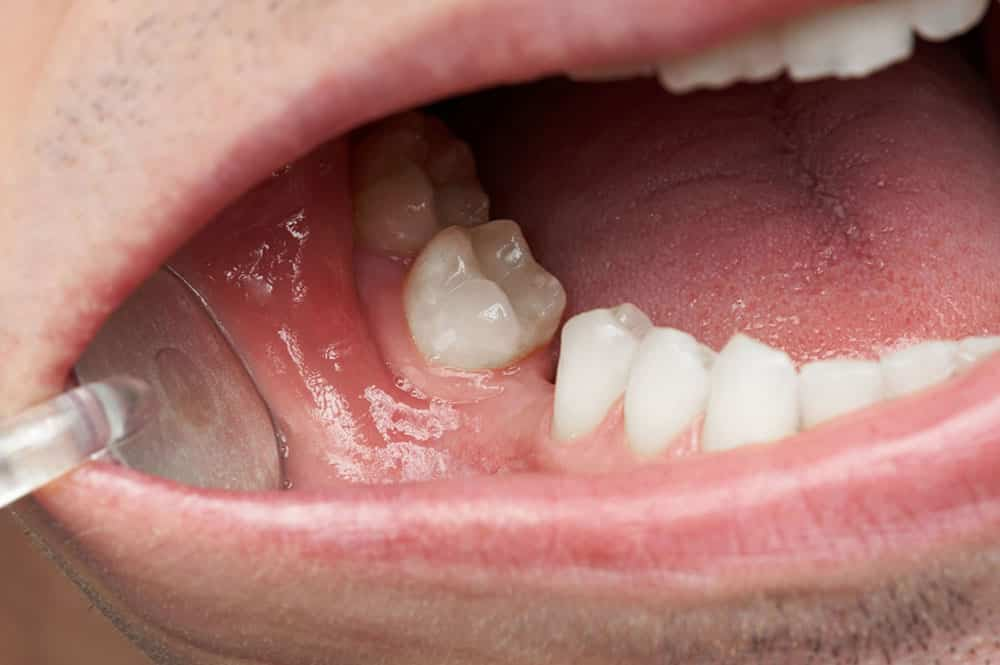 Missing molars can lead to many dental problems