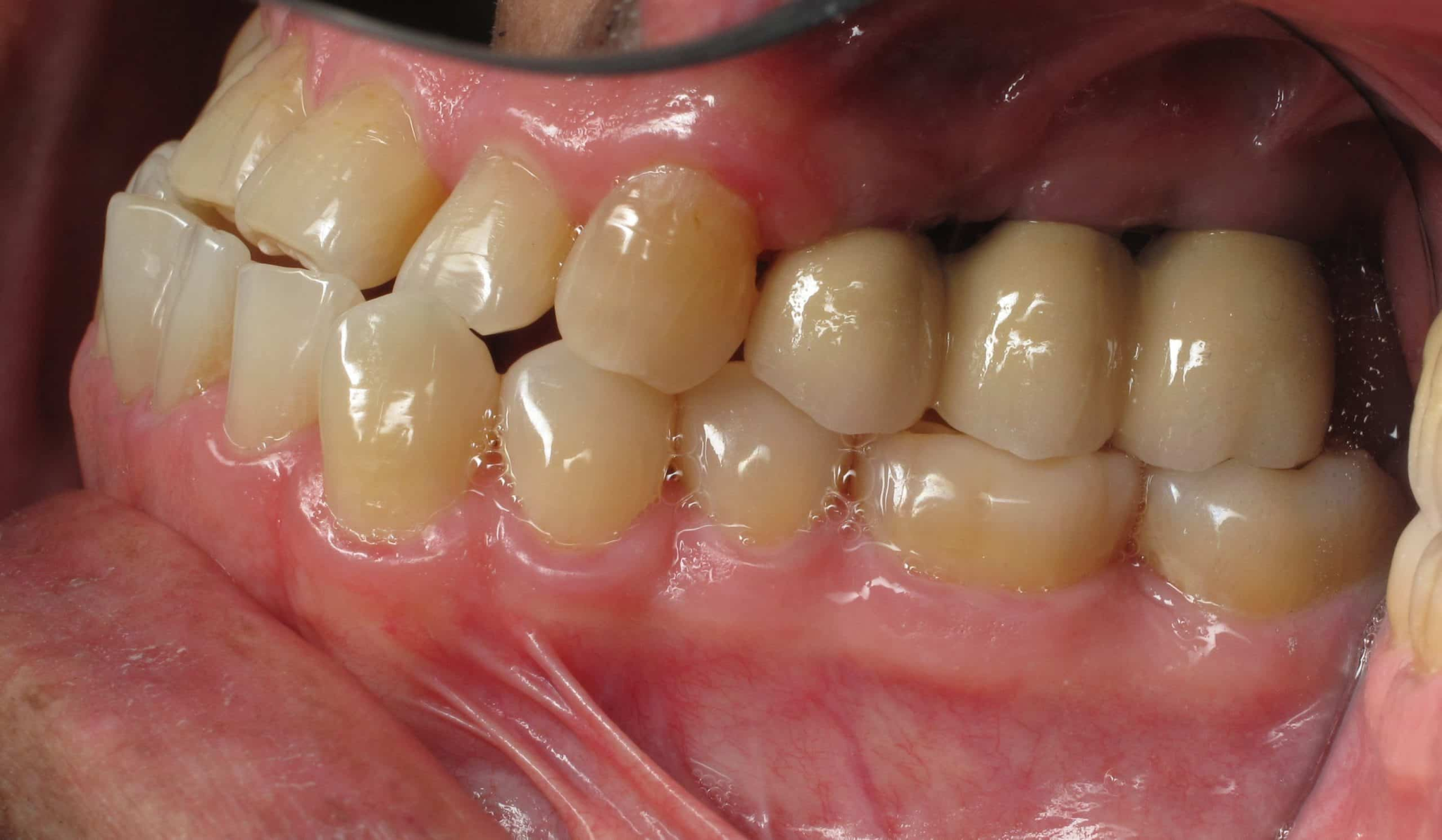 Molar implants help improve the chewing function of the teeth