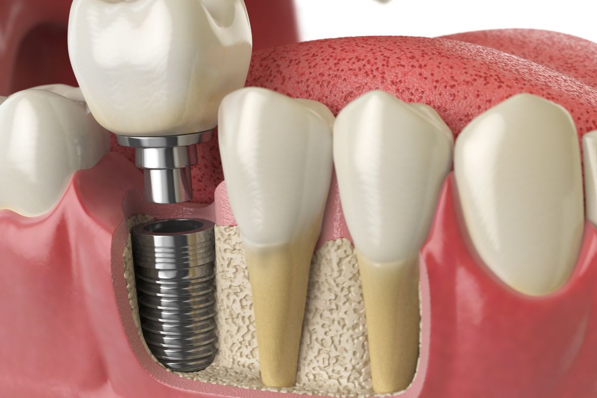 A molar dental implant is a permanent tooth replacement