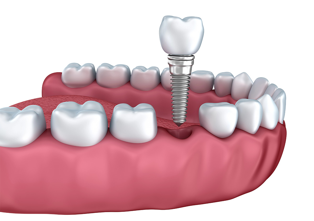 The Molar Implant Process at Azusa Dental Clinic