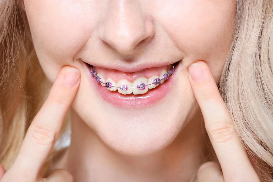 braces-farmington-smiling-patient