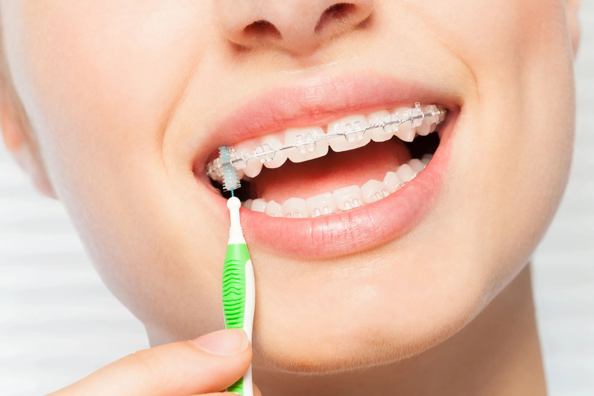 Cleaning Your Braces in Farmington
