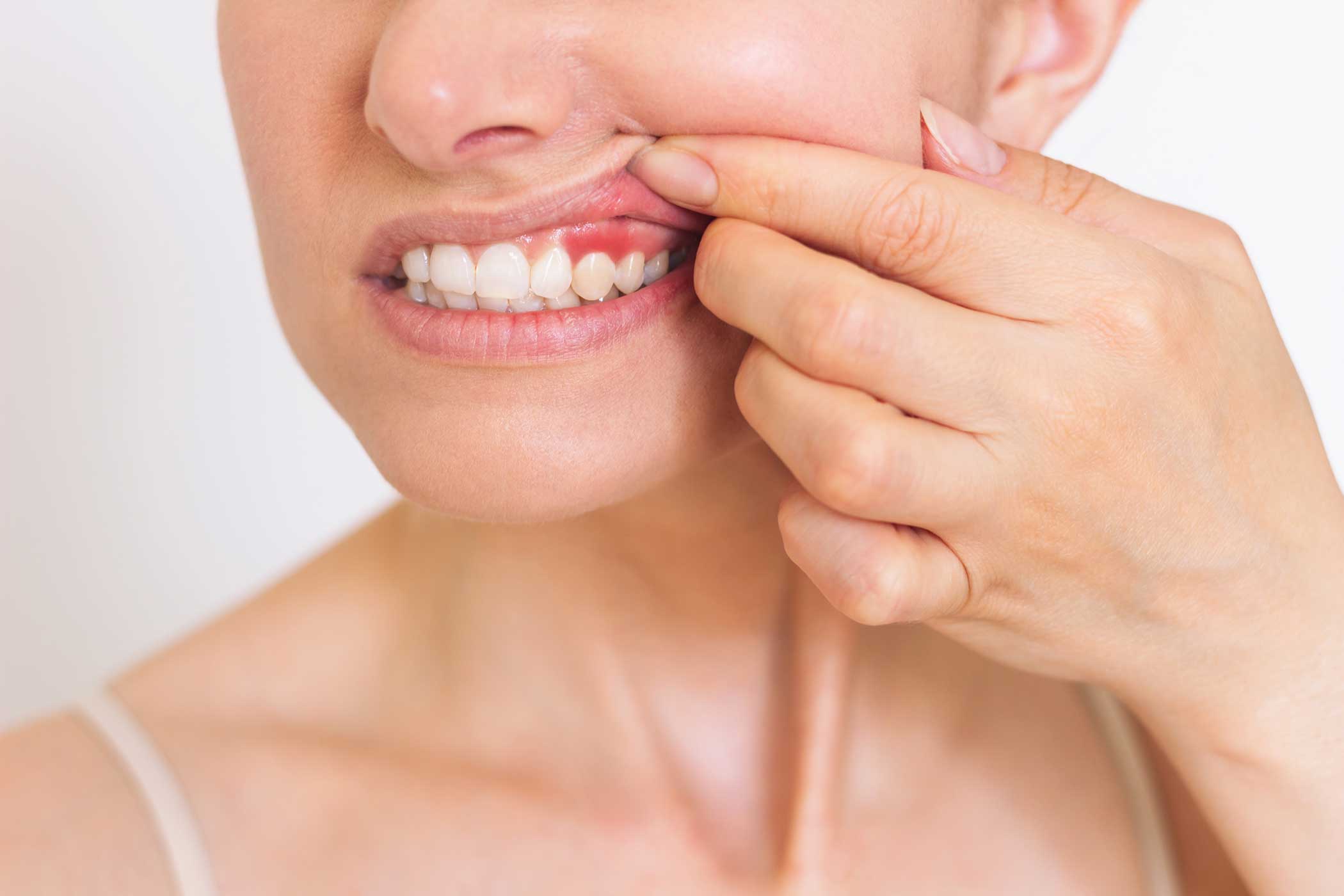 Photo d'une femme qui soulève sa lèvre pour monter ses gencives afin d'illustrer cette page Traitement parodontal du cabinet dentiste Jouve dans le 13011 à Marseille.