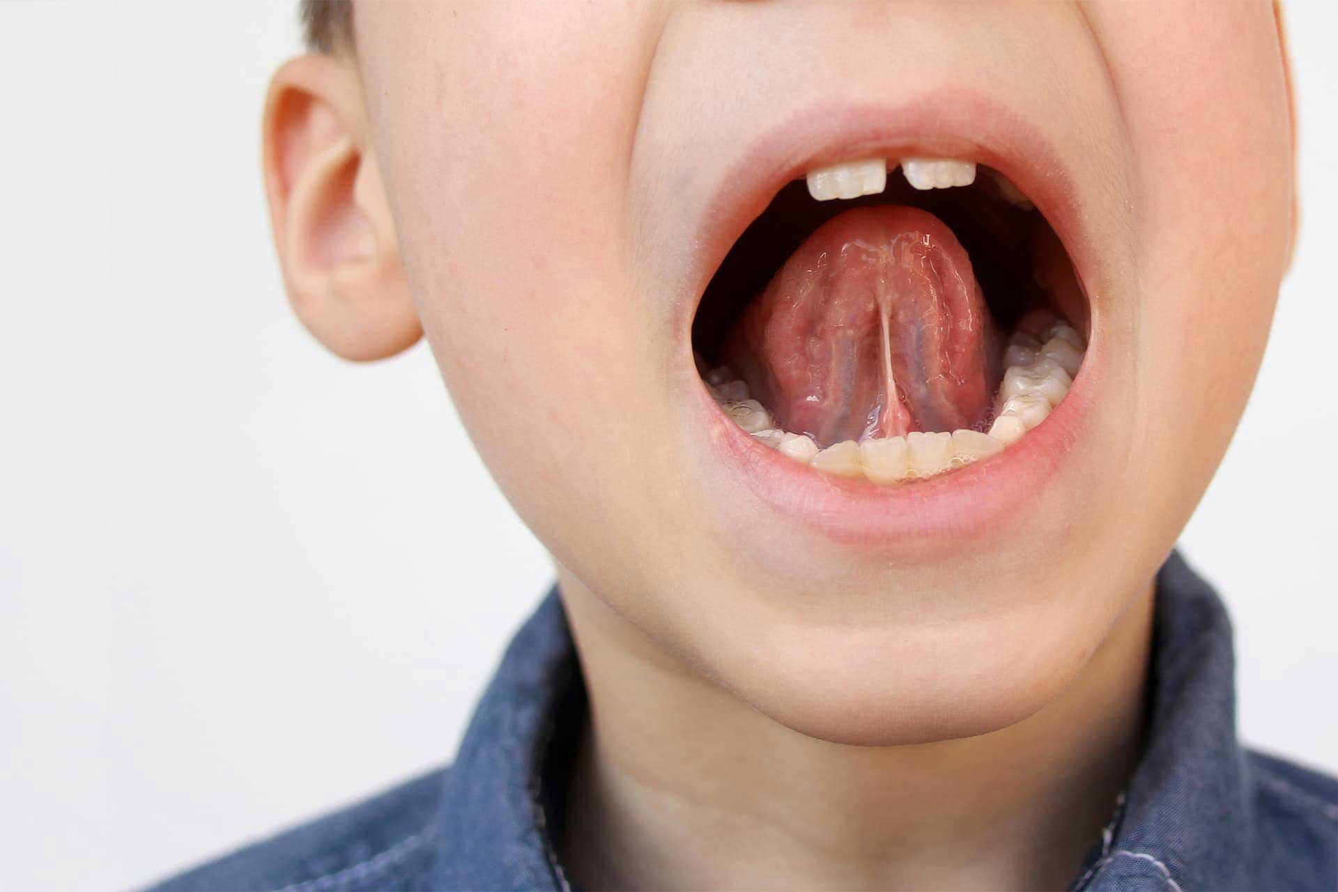 Photo du frein lingual dans la bouche d'un enfant.