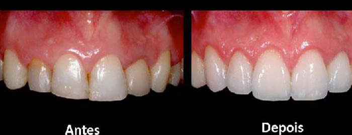 facetas estéticas e lentes de contato dental