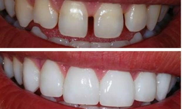 facetas estéticas e lentes de contato dental