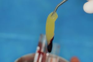 PRP e PRF na Odontologia