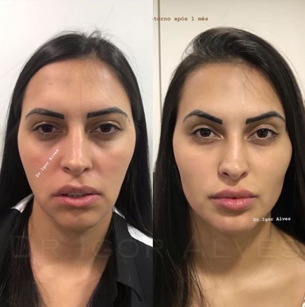 harmonização facial igor alves
