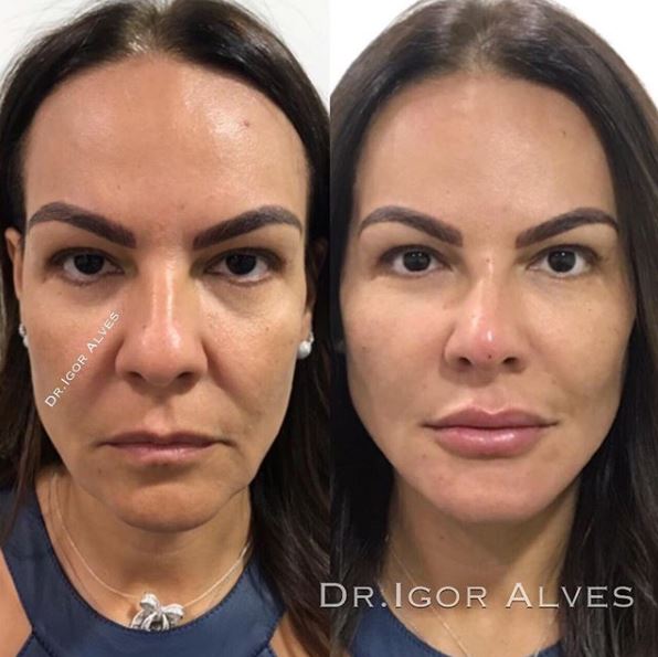 igor alves harmonização facial