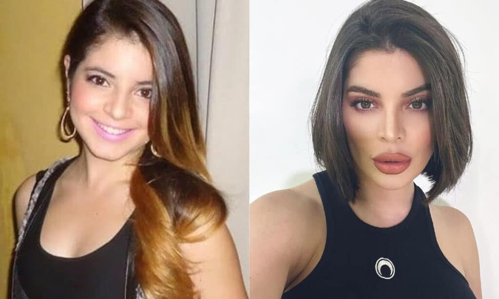 Gkay faz remoção do preenchimento labial