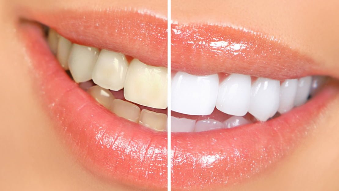 O clareamento dental é um procedimento utilizado por pacientes que querem deixar os dentes mais brancos.