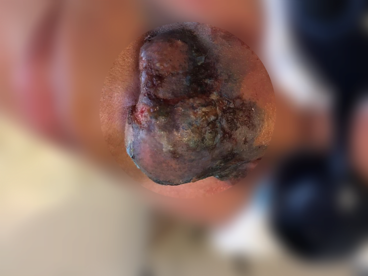 Erros estéticos causam cegueira enquanto dentista trabalha para reverter necrose em rinomodelação.