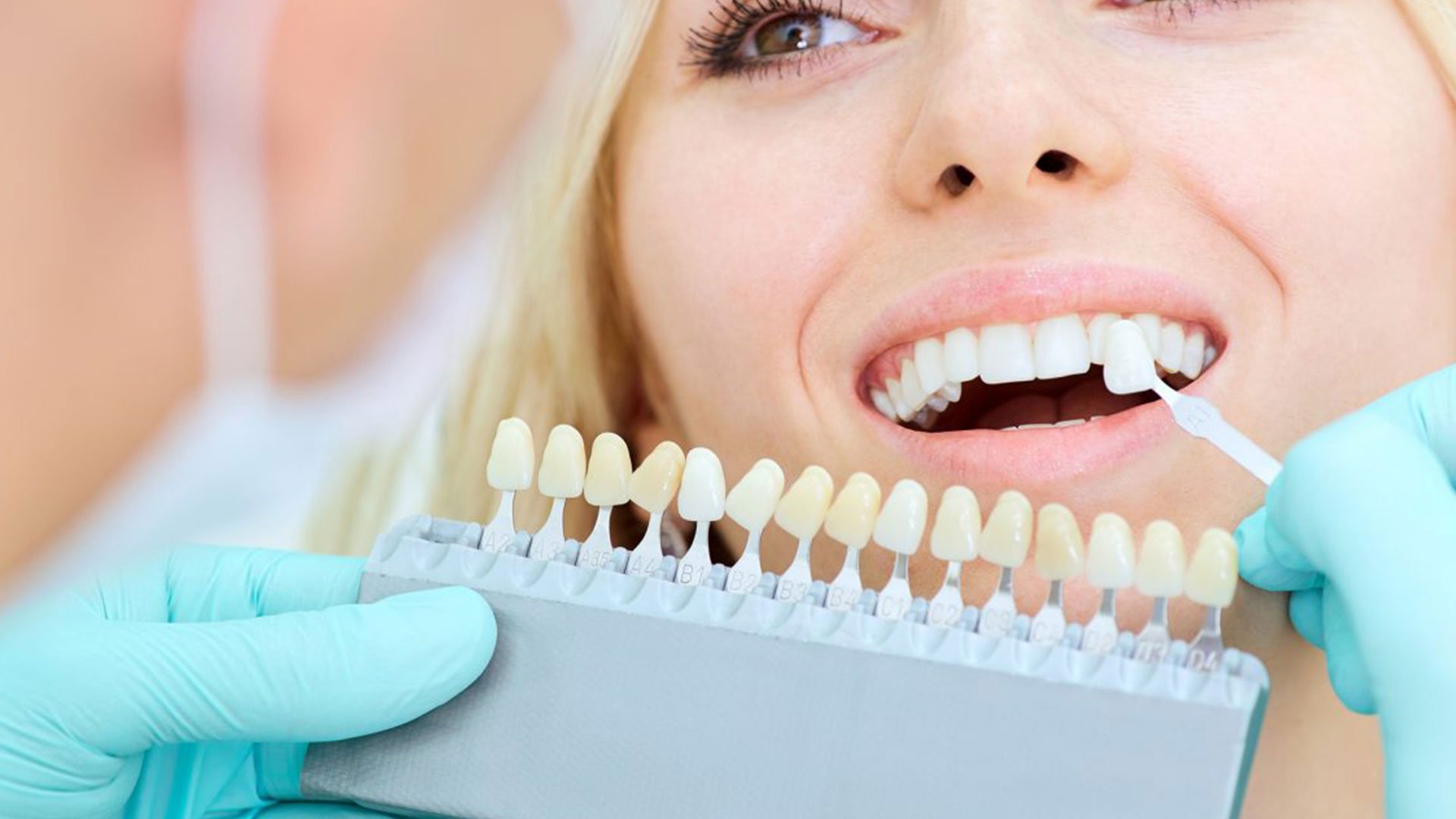 As lentes de porcelana dental caíram nas graças dos artistas e celebridades.