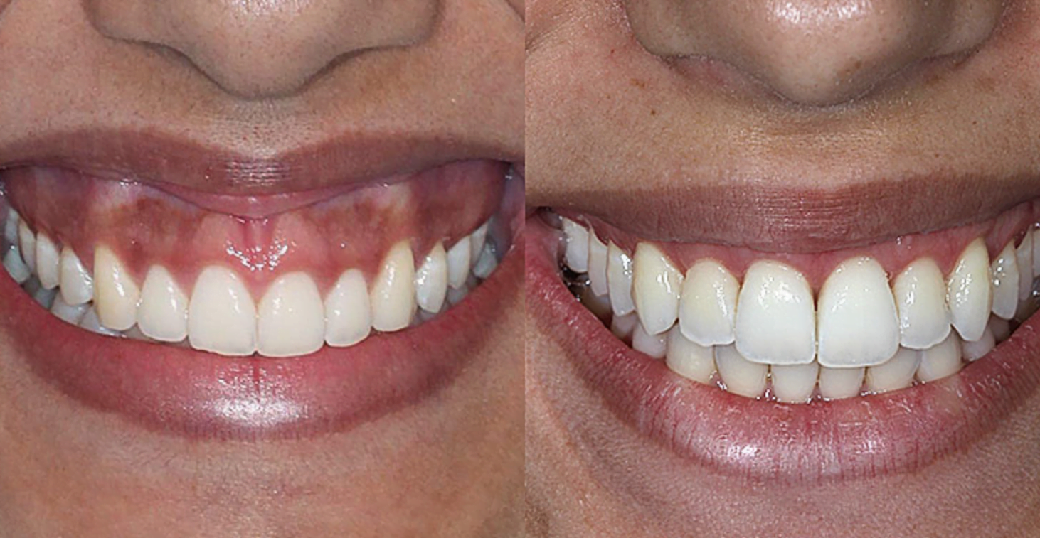Botox é o procedimento escolhido nos consultórios odontológicos para corrigir o sorriso gengival.
