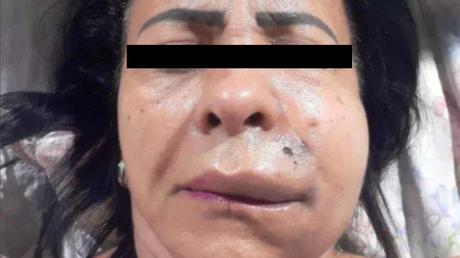 Harmonização facial mal sucedida realizada por dentista no Distrito Federal deixa sequelas graves, gera processo judicial e acarreta em agressão física.