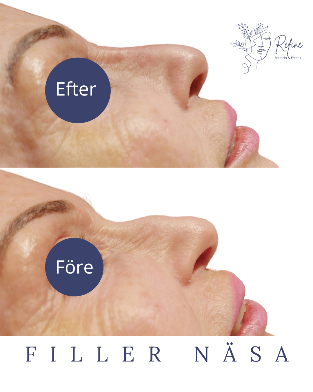 Före- och efterbilder av en kvinnas näsa som visar resultatet av en näsfillerbehandling.