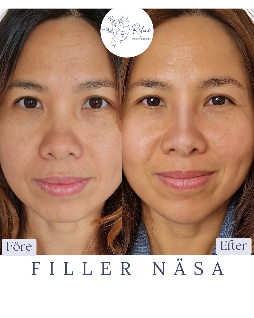 Före- och efterbilder av en kvinna som visar resultat av en näsfillerbehandling med jämnare och mer definierad näsform.