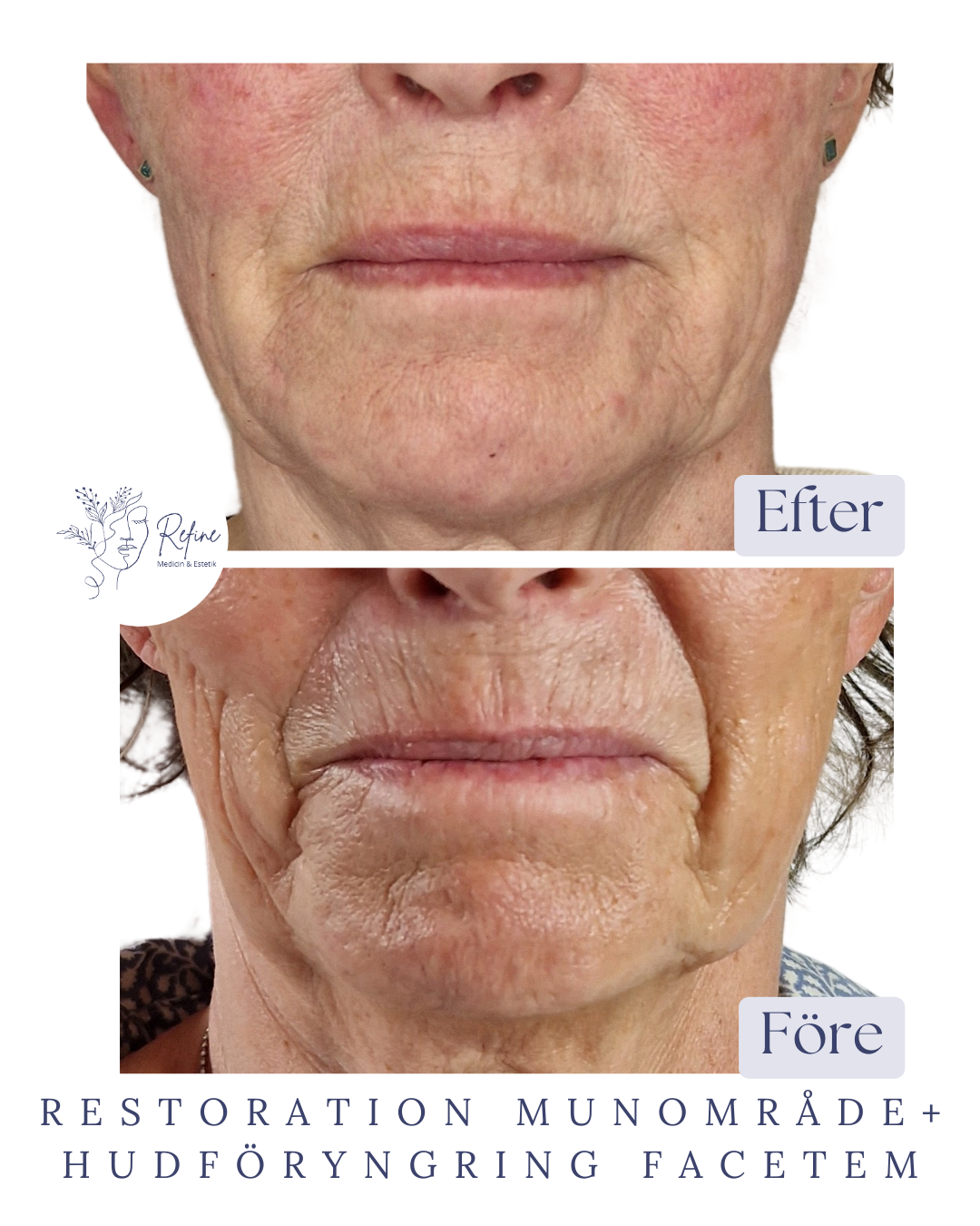 Närbild på en äldre kvinnas nedre ansikte före och efter behandling som visar minskade rynkor och slätare hud efter ansiktsföryngring och munområdeåterställning.