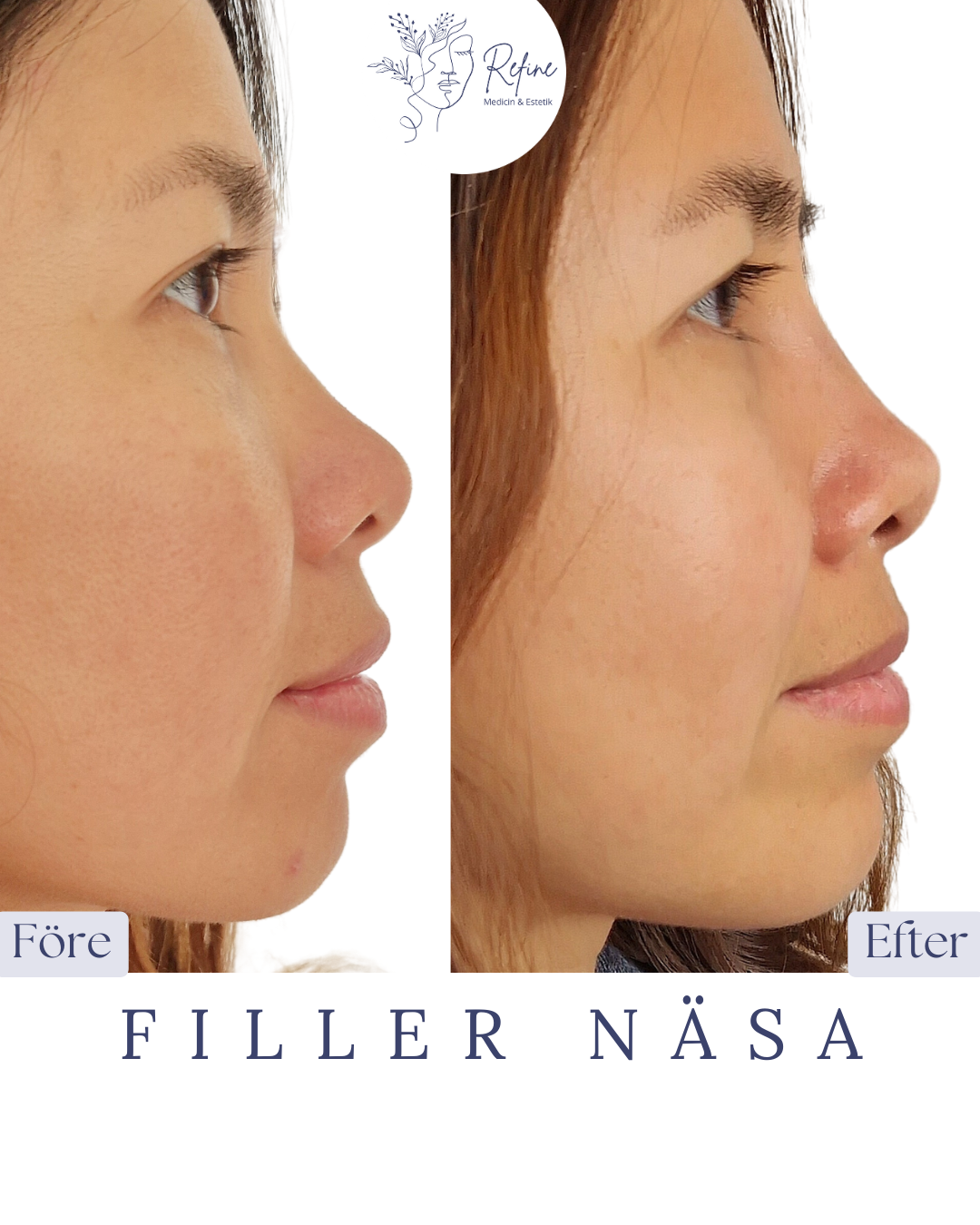 Profilbilder före och efter näsfillerbehandling som visar en jämnare näsrygg i efterbilden.