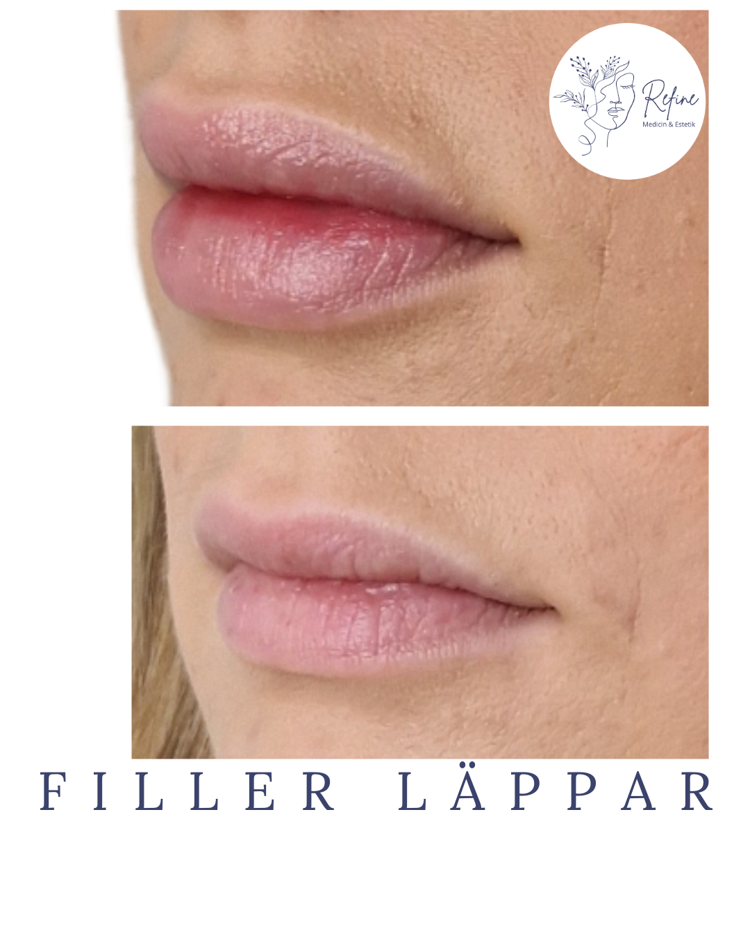 Närbild på läppar före och efter fillerbehandling som visar fylligare läppar.