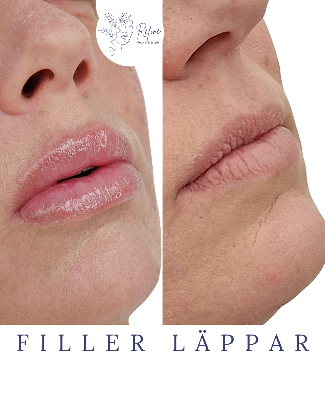 Före- och efterbild av läppar med fyllnadsbehandling, där läpparna ser fylligare och glansigare ut efter behandlingen.