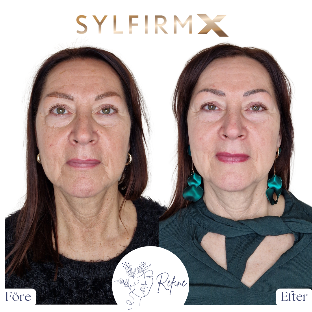 Före och efter bilder på en kvinna som visar hudförbättringar med SylfirmX-behandling, med minskade rynkor och jämnare hudton.