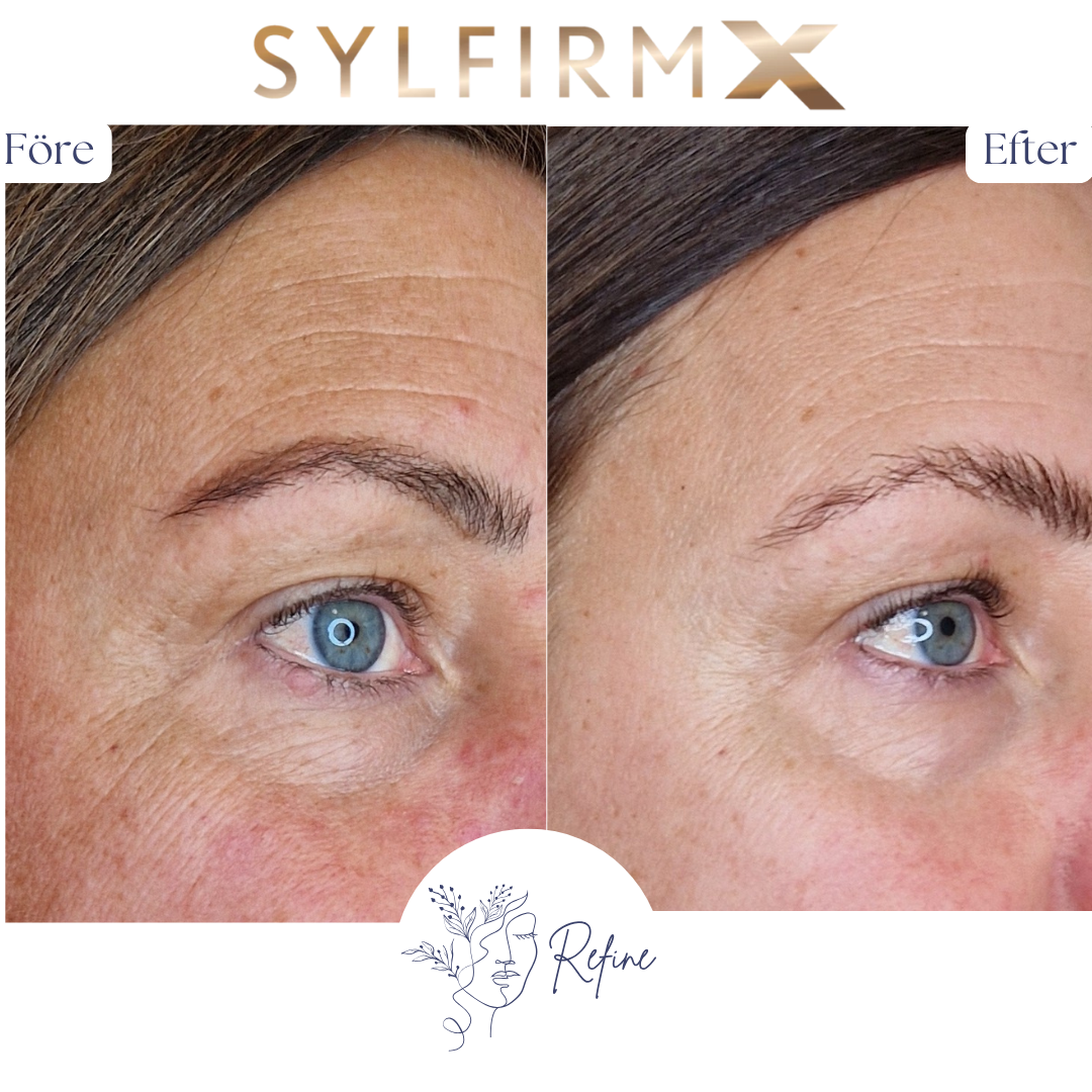 Närbild av en kvinnas ansikte före och efter hudbehandling som visar reducerade rynkor och jämnare hudton runt ögat.