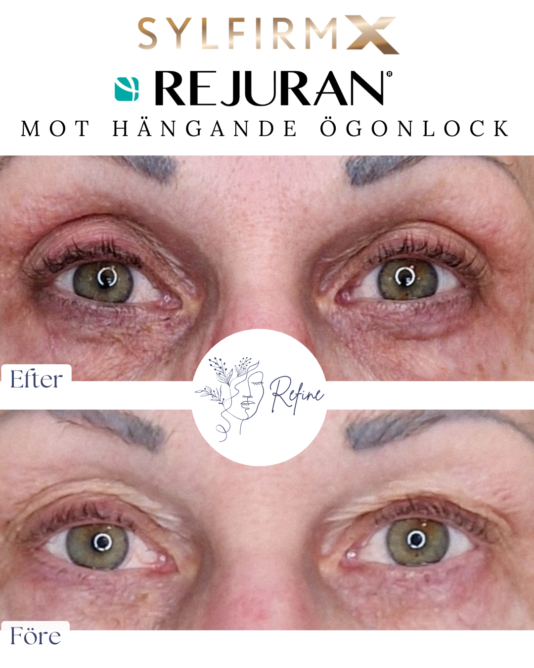 Före- och efterbilder på ögonlock som visar minskning av hängande hud runt ögonen efter behandling med Sylfirm X och Rejuran.