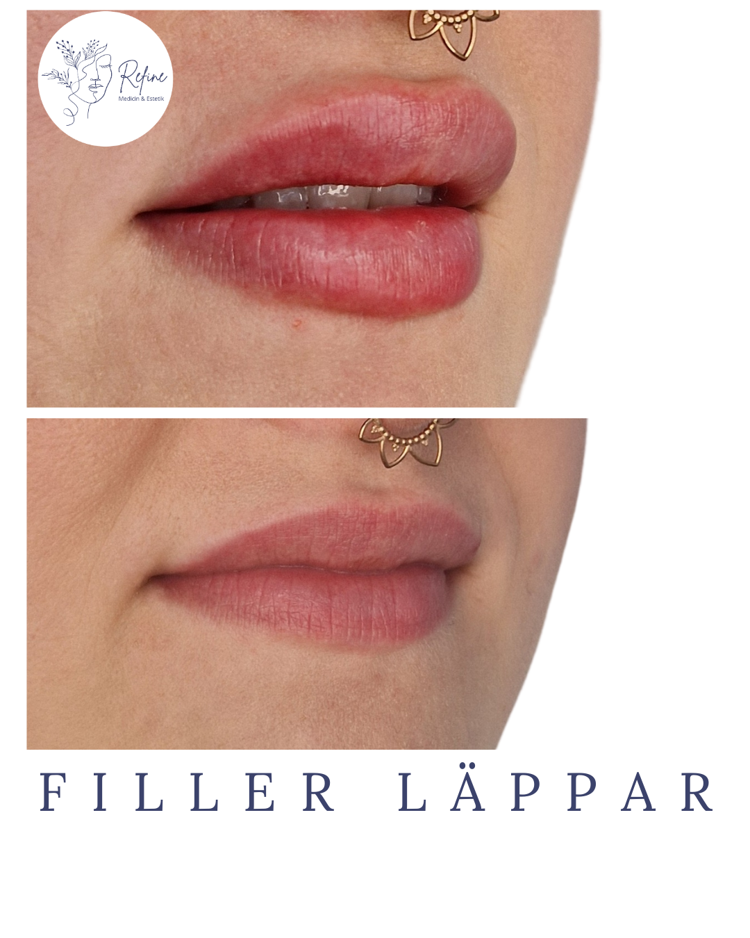 Före- och efterbilder av läppar med filler, där läpparna ser fylligare och mer definierade ut efter behandlingen.