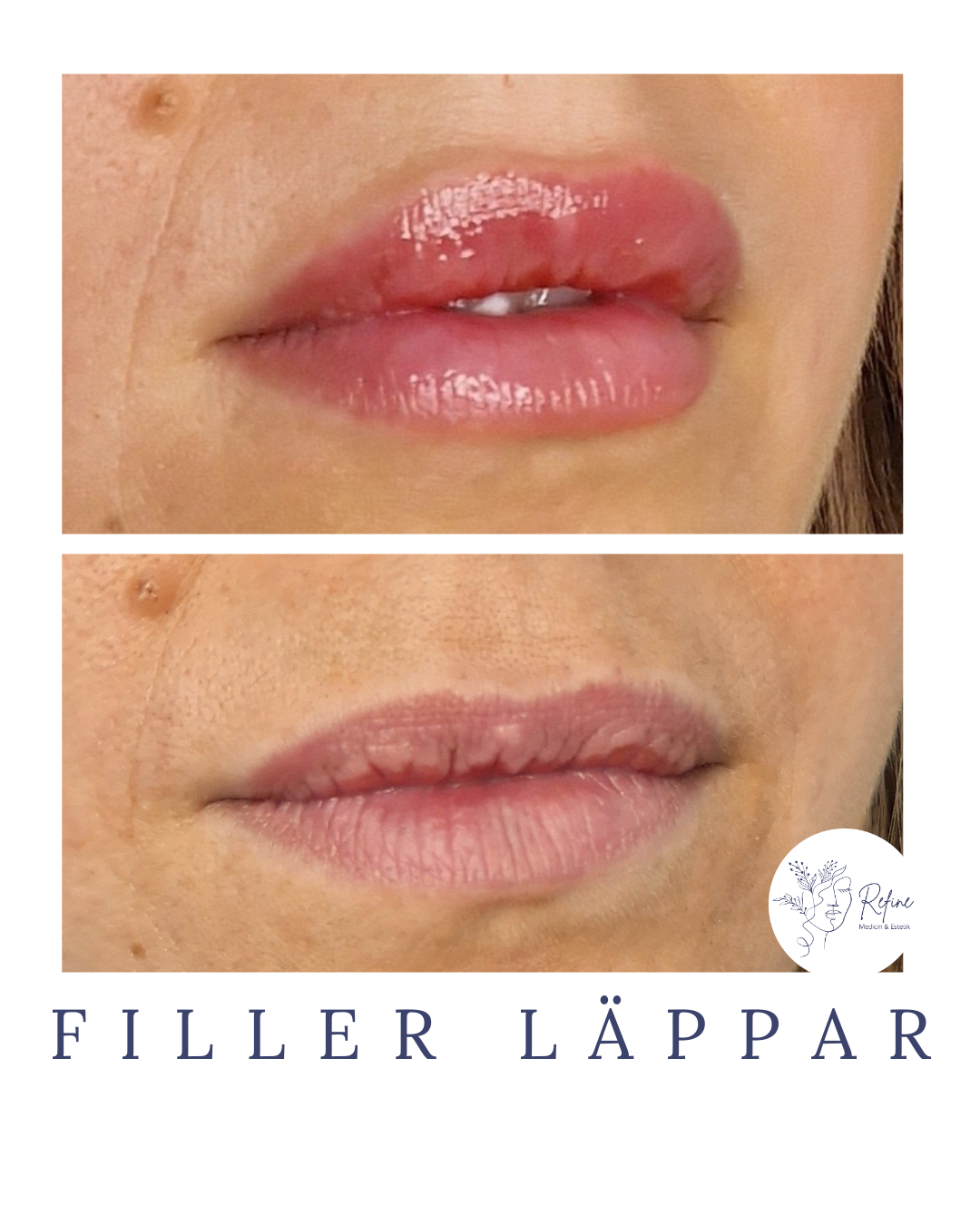 Närbild på läppar före och efter fillerbehandling som visar fylligare läppar på den övre bilden.