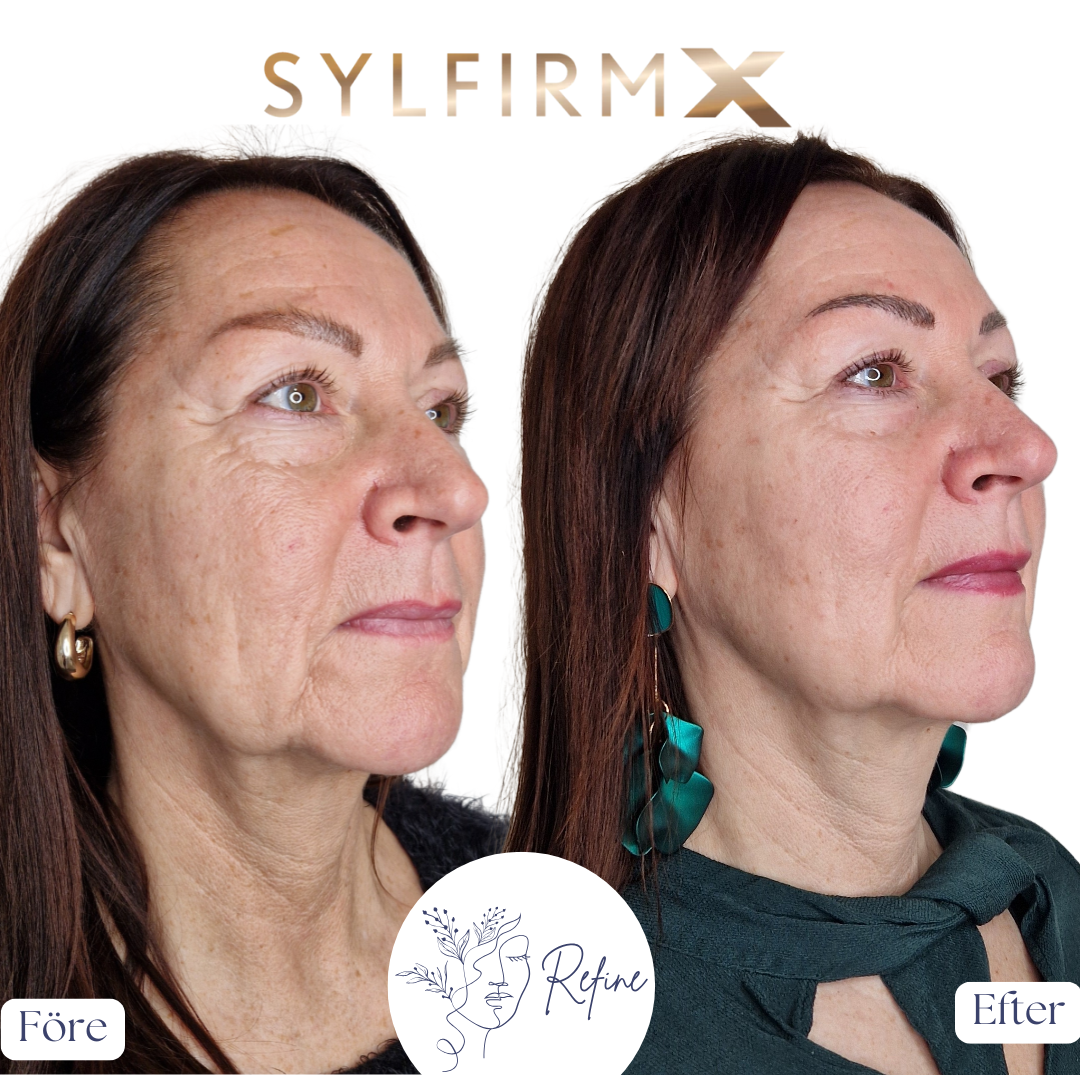 Före- och efterbilder av en kvinnas ansikte som visar förbättrad hudstruktur och färg efter behandling med SylfirmX.