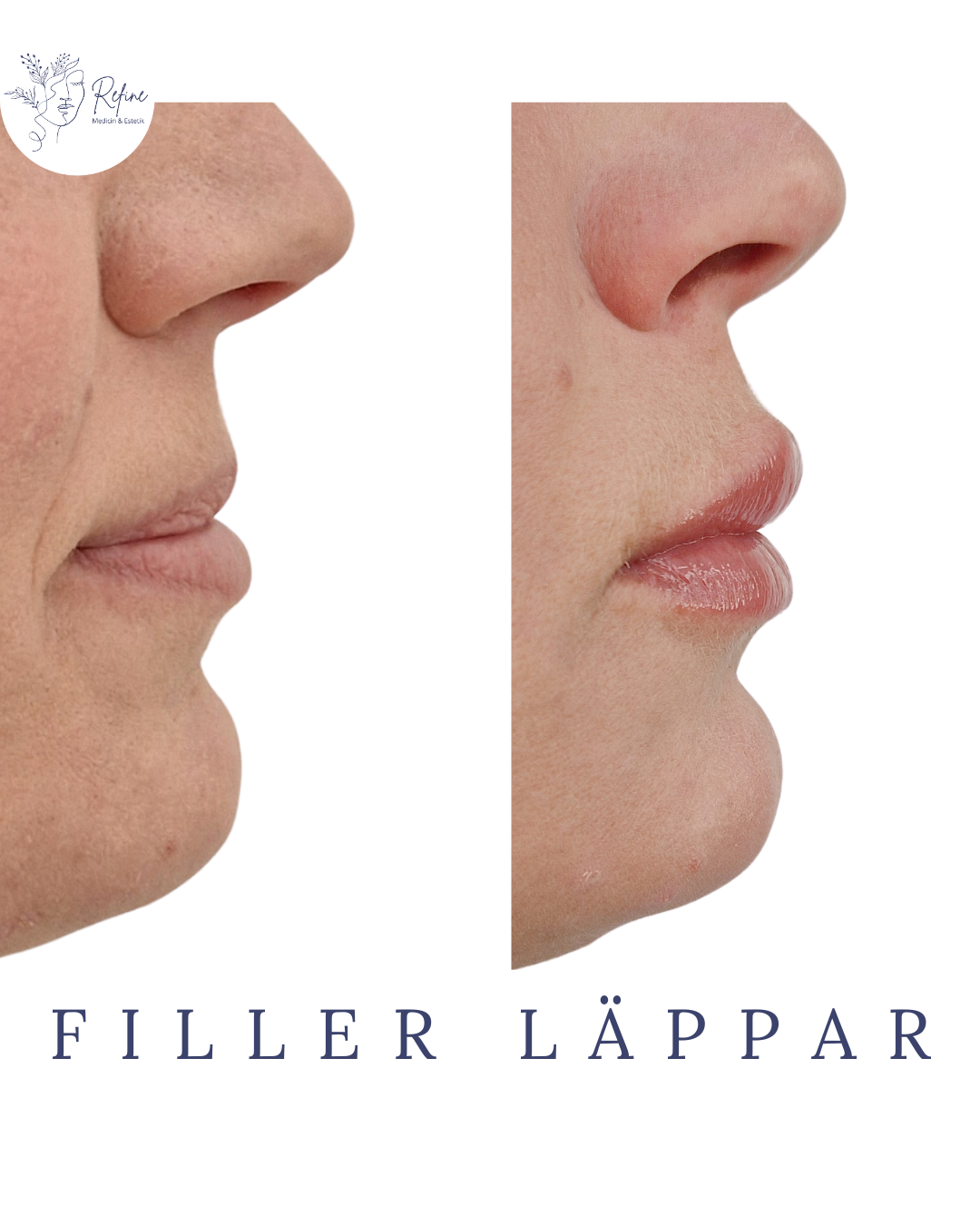 Före- och efterbild på läppar som har fått fillerbehandling för att öka volymen.