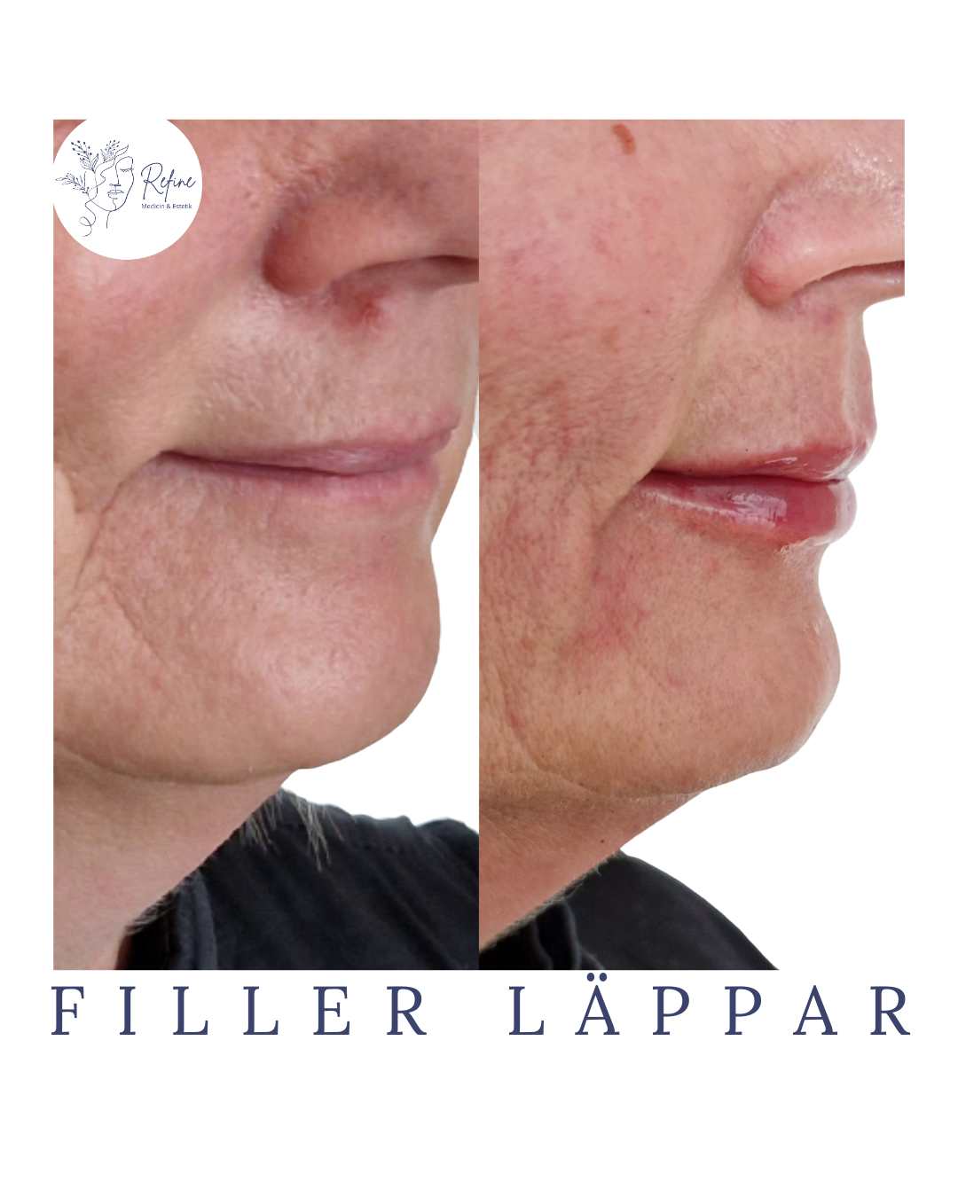 Närbild på en persons läppar före och efter fillerbehandling, med fylligare läppar efteråt.