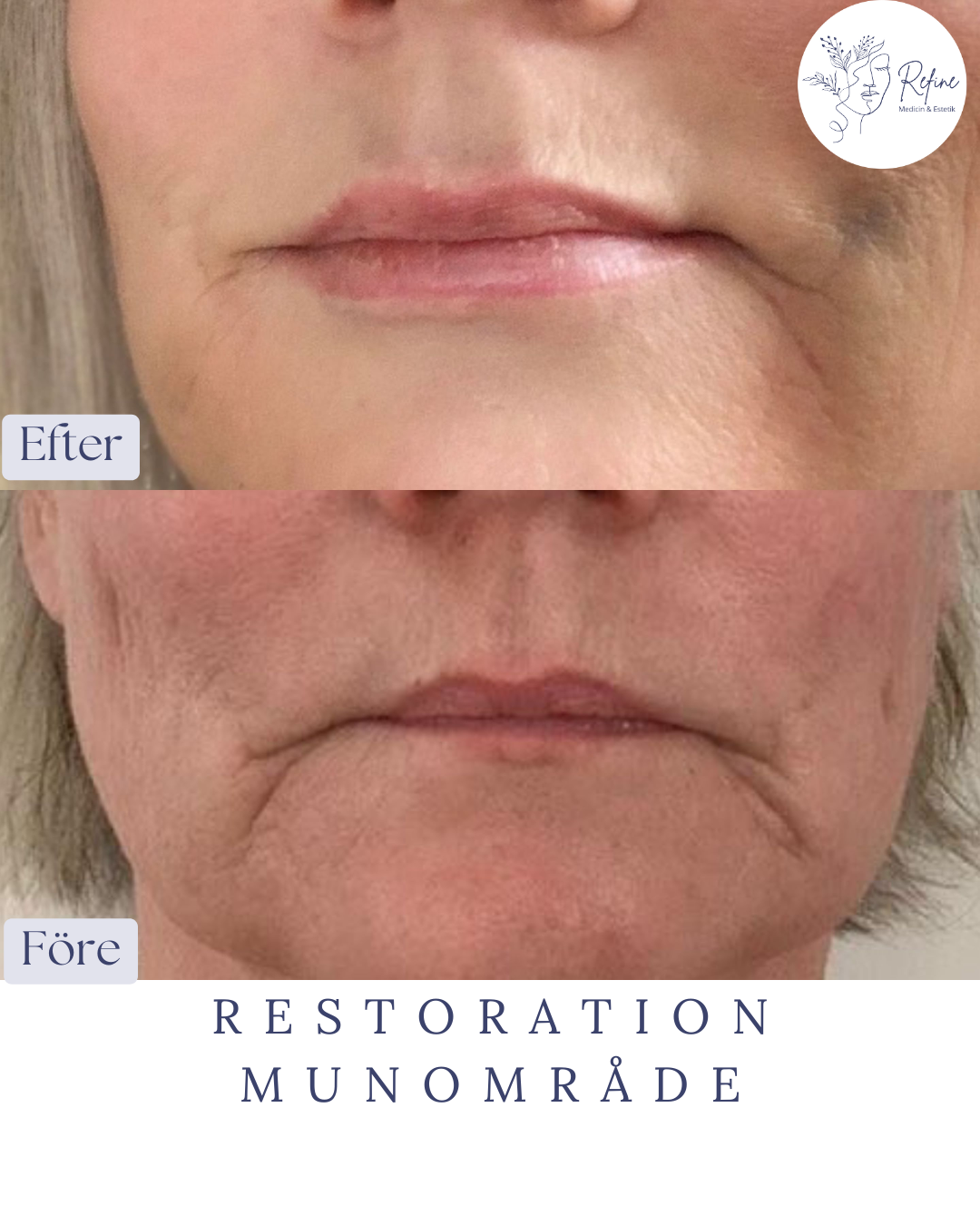 Före- och efterbilder av munområdet som visar reducerade rynkor och slätare hud efter behandling.