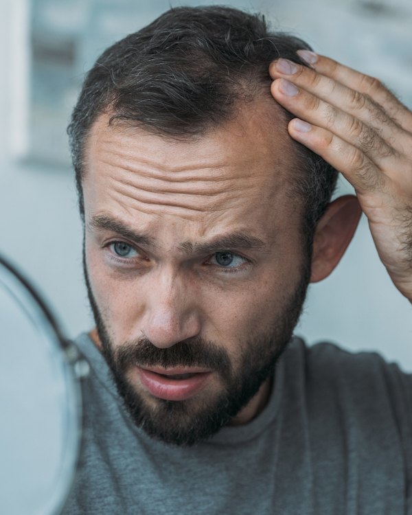 Man med mörkt hår och skägg som inspekterar sin hårbotten i spegel och oroar sig för håravfall.