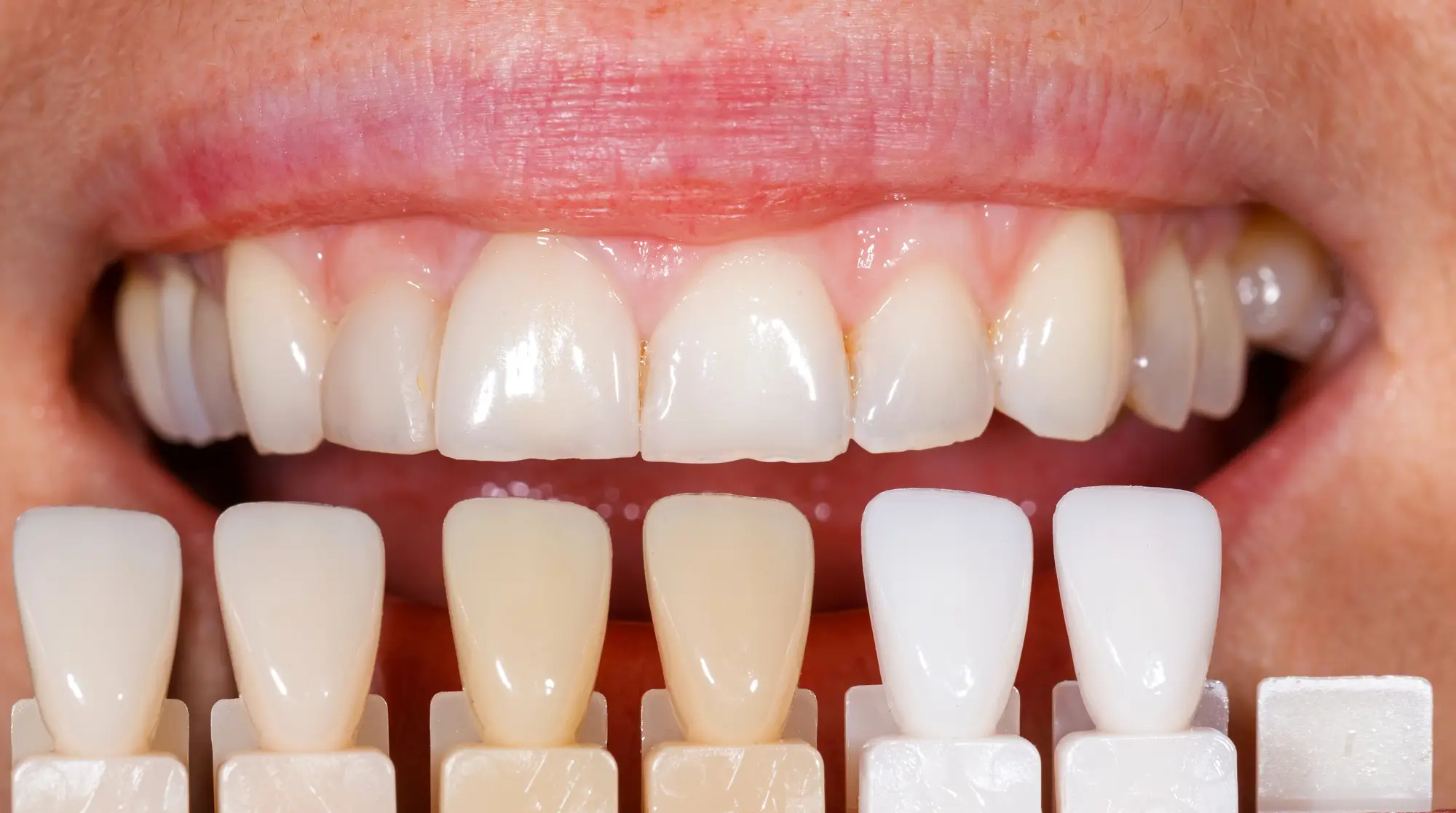 Shade determination by cosmetic dentist in Springfield, PA