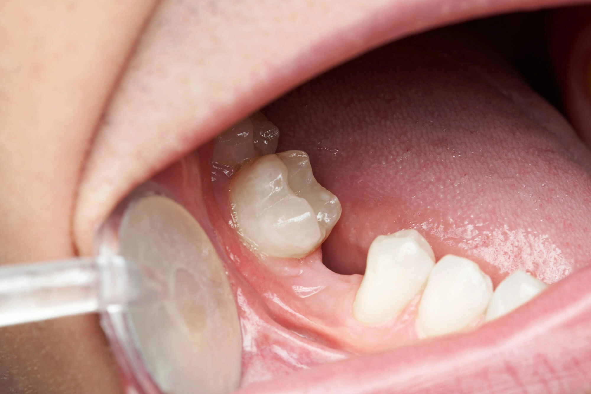 Gap in teeth needs dental bridges allentown