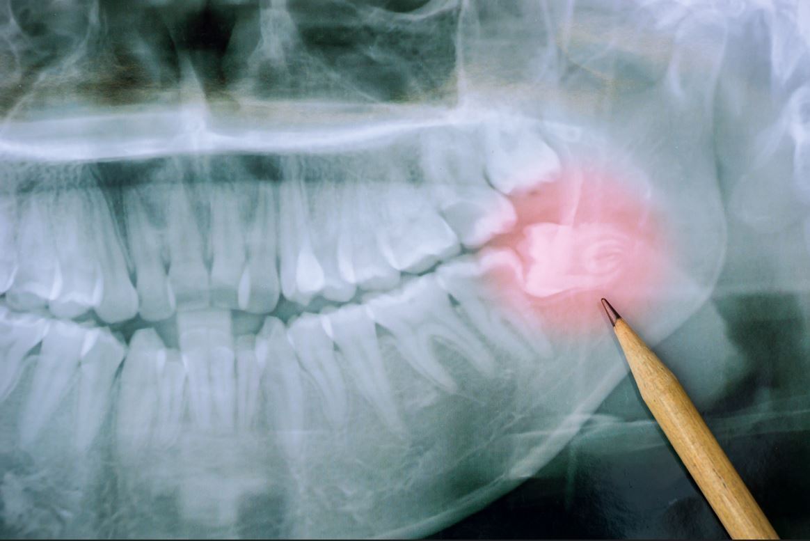 Röntgenbild eines Weisheitszahnes zum Ziehen von Weisheitszähnen