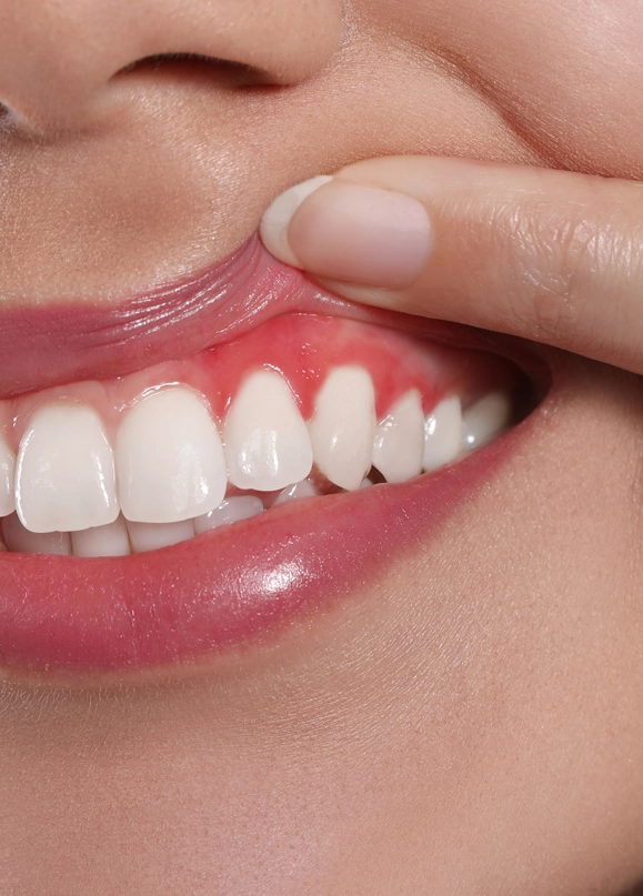 Close-up of a person pulling up their lip to show healthy white teeth and pink gums.
