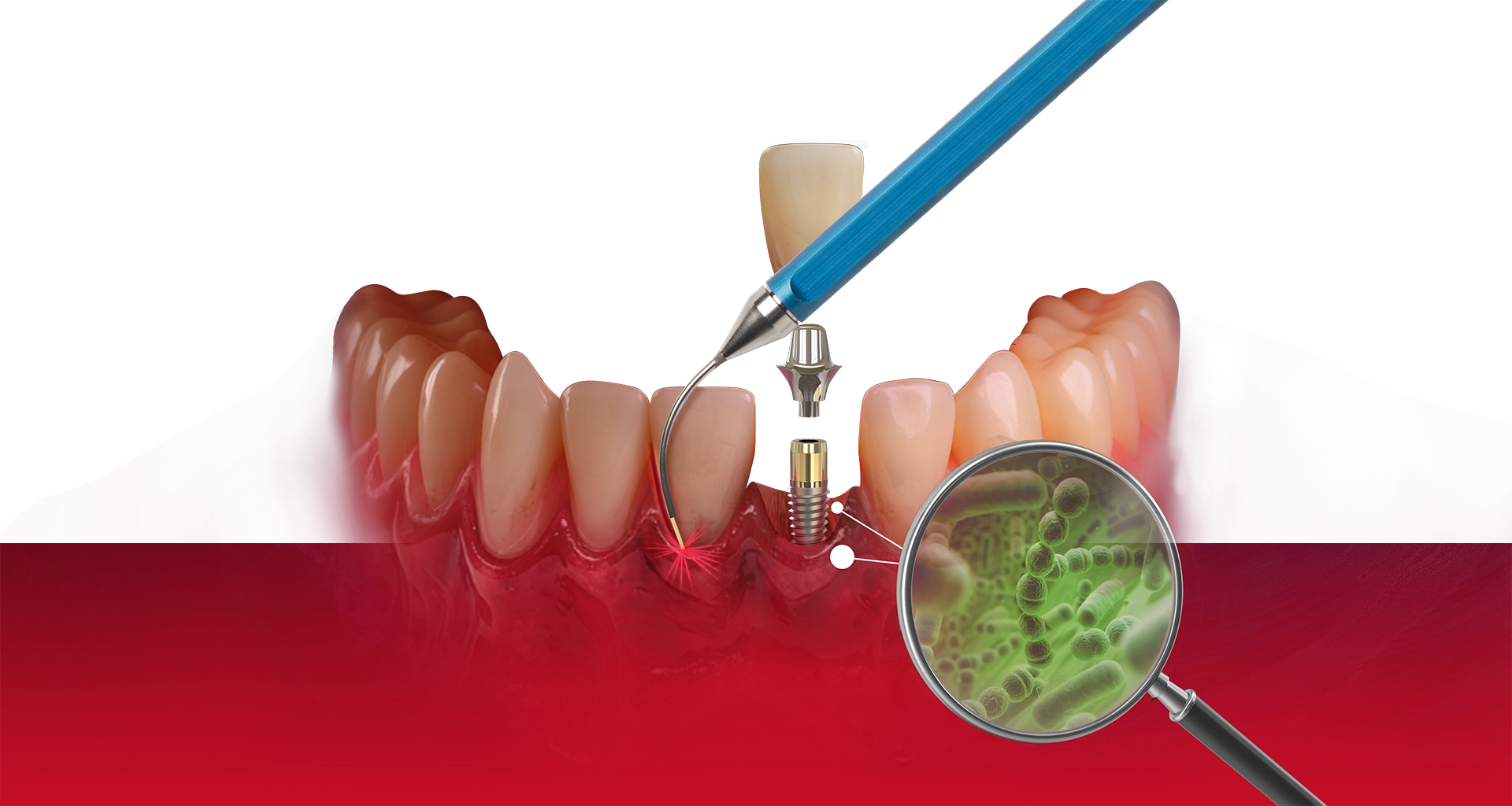 Dental implant illustration showing gum tissue with a laser tool and magnified bacteria near the implant site.