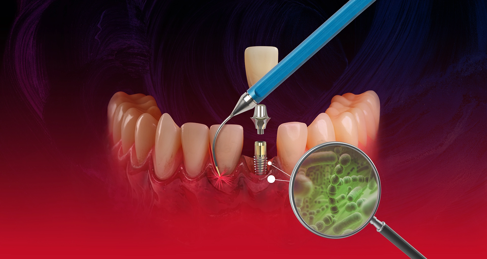 Illustration of dental implant installation with a blue dental tool applying laser therapy on gums, showing bacteria under a magnifying glass.