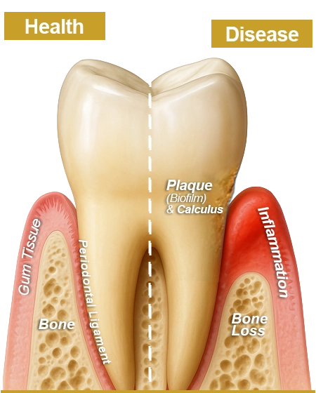 Cross-section of a tooth comparing healthy left side with intact gum tissue, bone, and periodontal ligament to diseased right side showing plaque, calculus, inflammation, and bone loss.