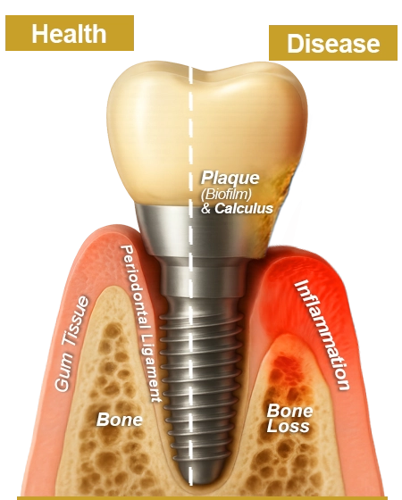Cross-section of a dental implant showing healthy gums and bone on the left with intact gum tissue, periodontal ligament, and bone, and diseased gums on the right with plaque, calculus, inflammation, and bone loss.