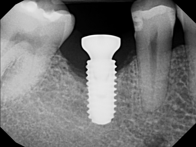 Dental X-ray showing a titanium dental implant placed between two natural teeth.