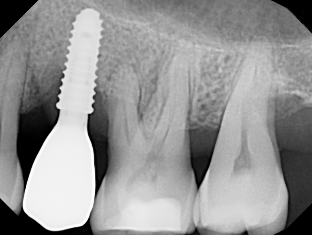 Dental X-ray showing a dental implant on the left and two natural molars on the right.