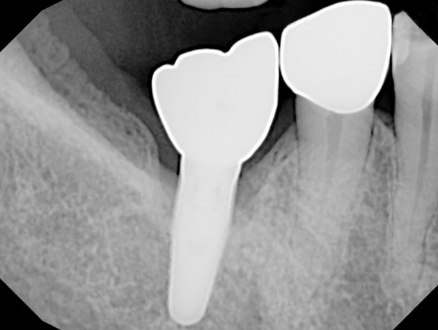 Dental X-ray showing two adjacent teeth with metal crowns and one with a dental implant post in the jawbone.