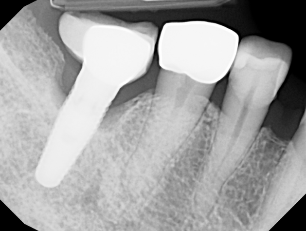 Dental X-ray showing a dental implant with a crown alongside two natural molar teeth, one with a dental crown.