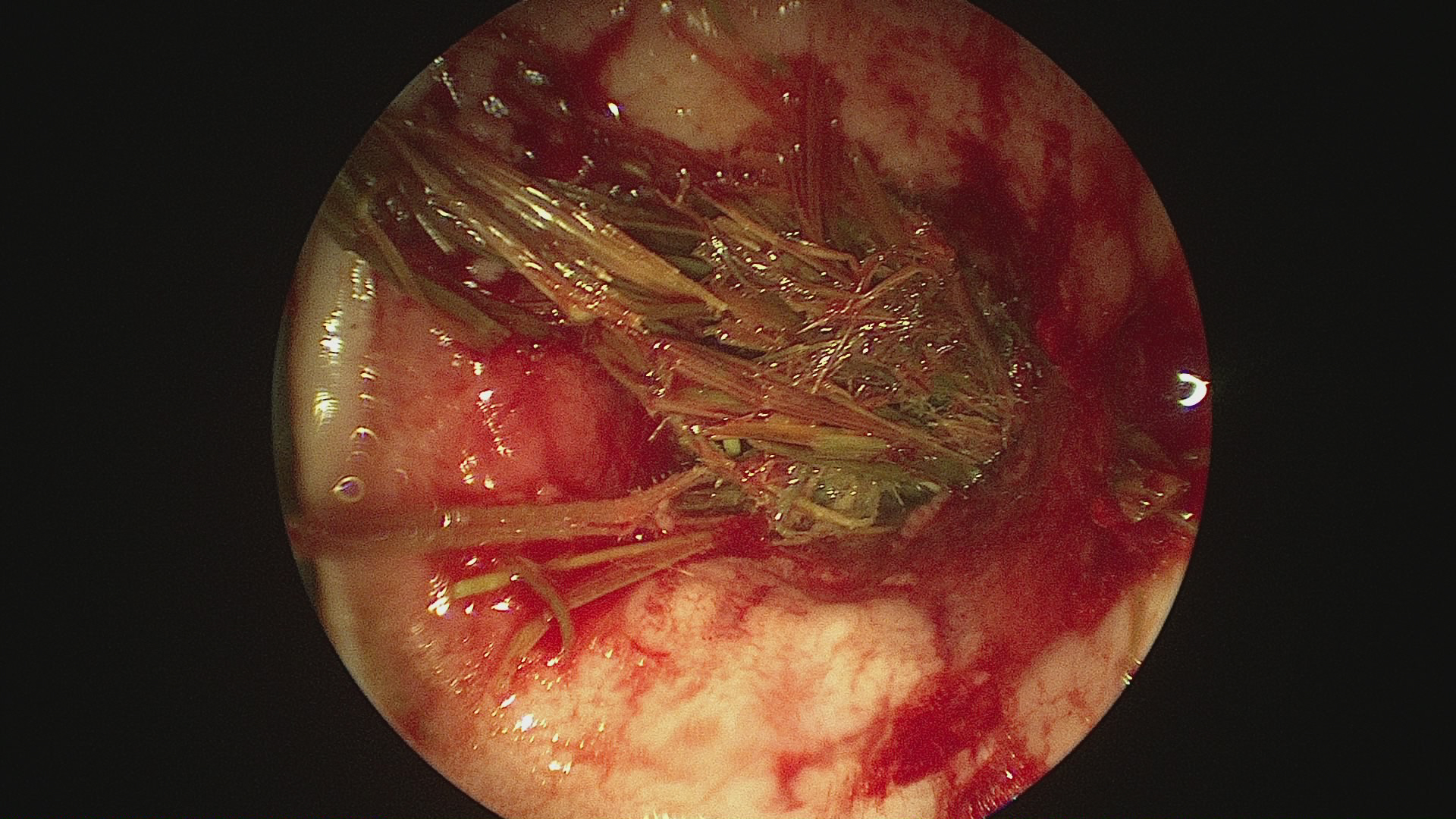 Feed in a fistula