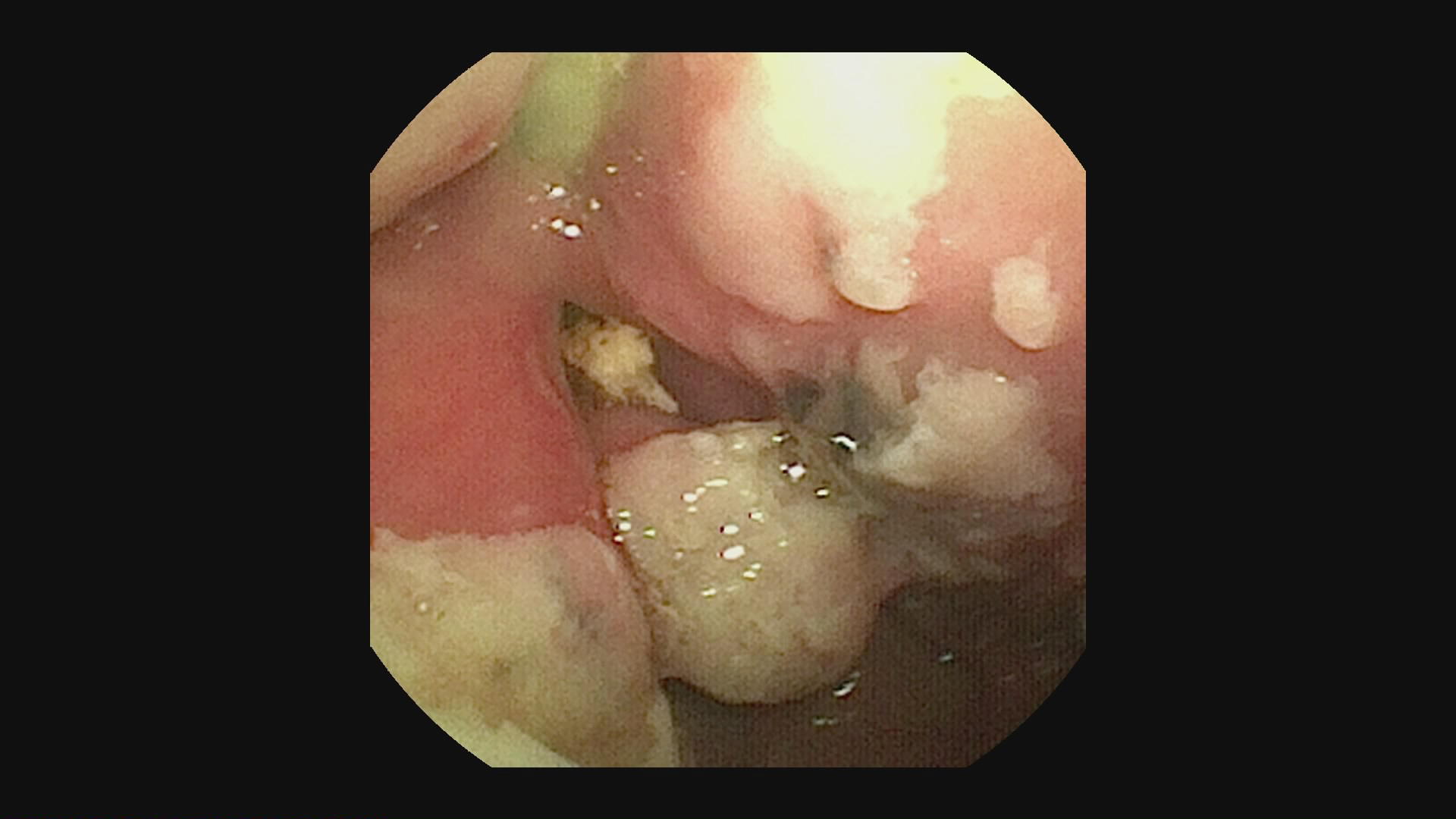 Pus and feed in the sinus