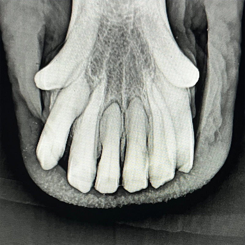 Mandibular incisors with EOTRH